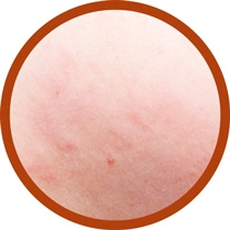 What Does a Bed Bug Bite Look Like?